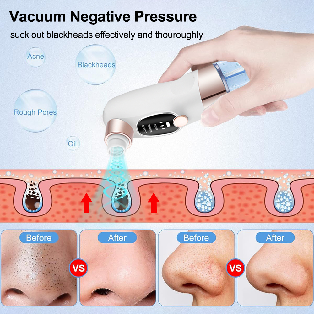 Blackhead Remover Electric Bla – Pore Vacuum Bewertung und Preis