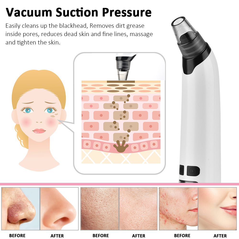 Blackhead Remover Electric Fac – Pore Vacuum Bewertung und Preis