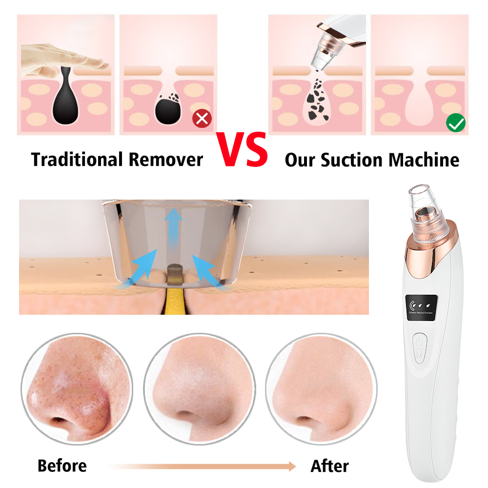 Blackhead Remover Vacuum Sucti – Pore Vacuum Bewertung und Preis
