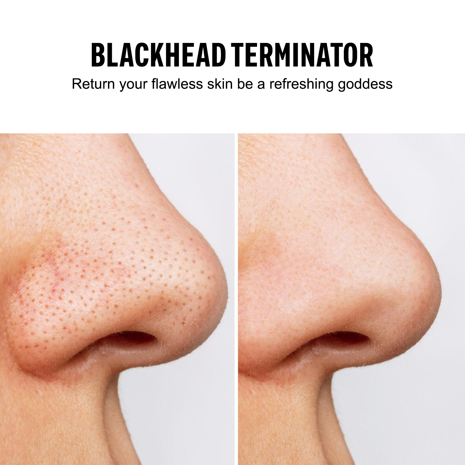 Blackhead Remover Vacuum Sucti – Pore Vacuum Bewertung und Preis