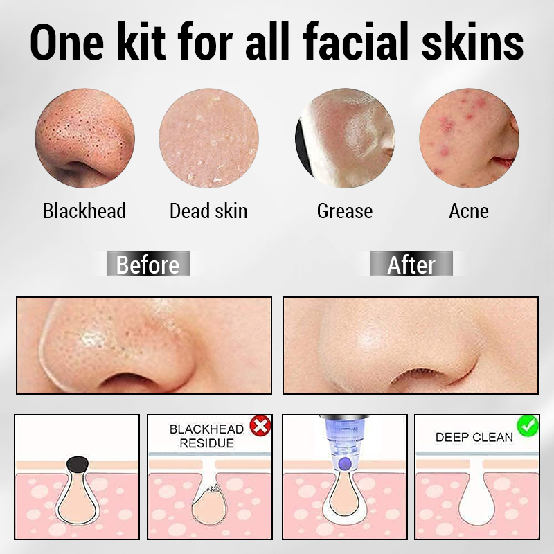 3 IN 1 Suction Blackheads God  – Pore Vacuum Bewertung und Preis